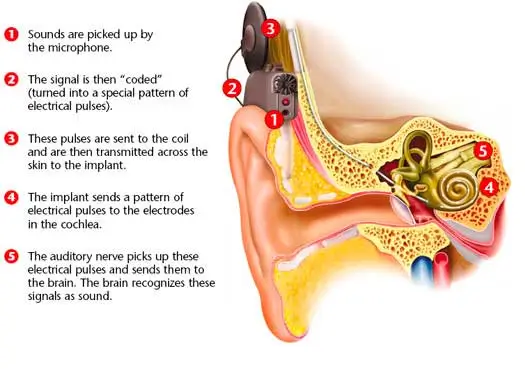 Benefits of cochlear implant in Pakistan
