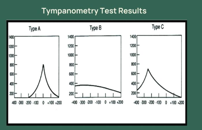 tympanometry test results